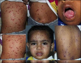 Chickenpox