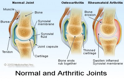 Arthritis