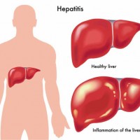 Hepatitis