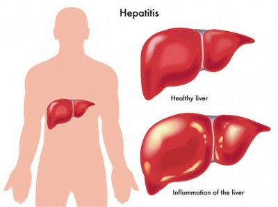 Hepatitis