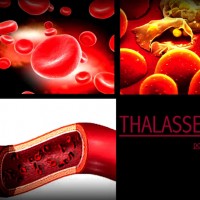 Thalassemia