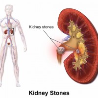 Kidney Stones