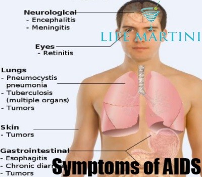 Symptoms of AIDS