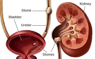 Kidney Stones