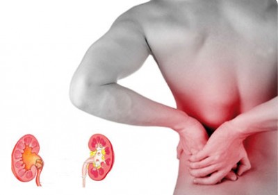 Symptoms of Kidney Stones