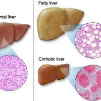 Liver Diseases