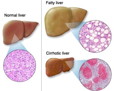 Liver Diseases