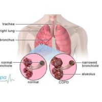 COPD