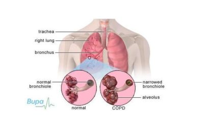 COPD