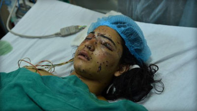 Kashmir Pellet Gun Injuries