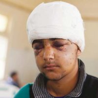 Boy from Kashmir Injured in Pellet Gun Attack