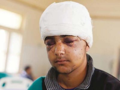 Boy from Kashmir Injured in Pellet Gun Attack