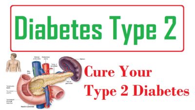 Diabetes Type 2