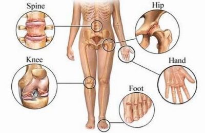 Chikungunya Symptoms