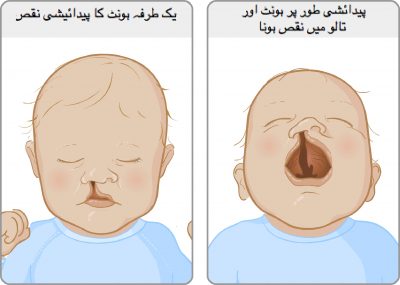 Cleft Lip Palate