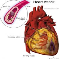 Cholesterol Heart Attack