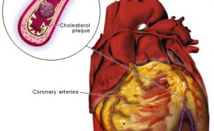 دنیا میں سب سے زیادہ اموات كولیسٹرول بڑھنے کی وجہ سے ہارٹ اٹیک سے ہوتی ہیں