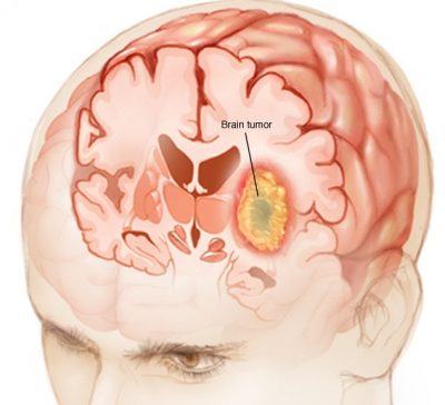 Brain Tumor